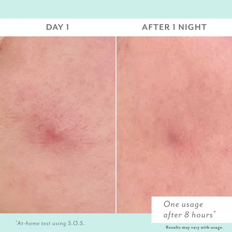 S.O.S. Clarifying Liquid Pimple Patch
